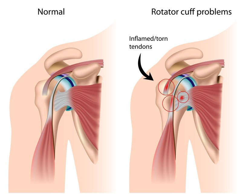 Common rotator cuff shop injuries