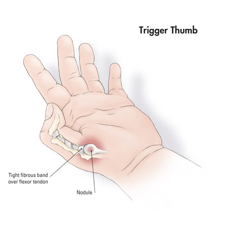 trigger finger( thumb)