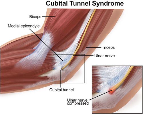 image of cubital-tunnel-syndrome