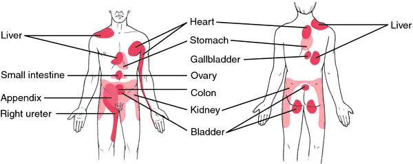 Referred Pain | Orchard Health CLinic