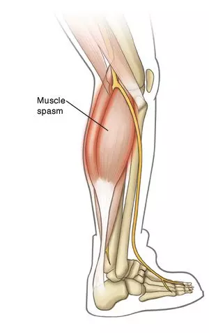 Muscle Spasm | Orchard Health Clinic