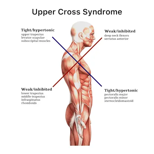Upper Cross Syndrome | Orchard Health Clinic