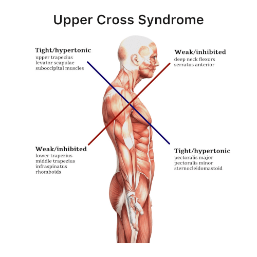 Upper Cross Syndrome Orchard Health Clinic Osteopathy upper-cross-syndrome-orchard-health-clinic-osteopathy