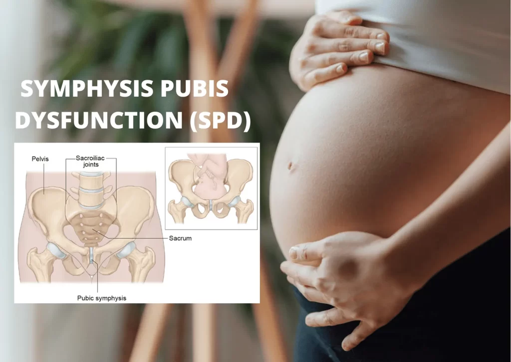 Symphysis Pubis Dysfunction | Orchard Health Clinic