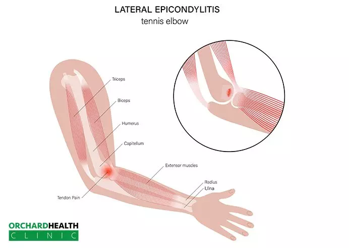 What is Tennis Elbow-Tennis Elbow treatment-Lateral Epicondylitis | Golfers Elbow vs Tennis Elbow