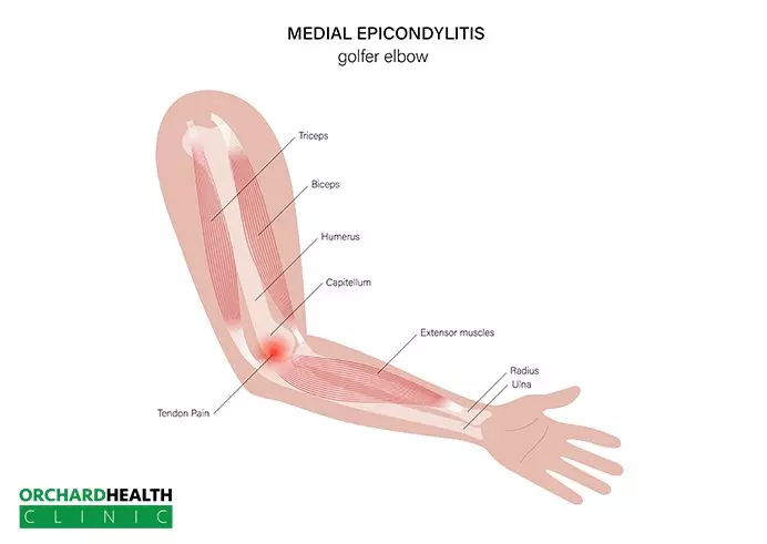 What is Tennis Elbow-Tennis Elbow treatment Medial Epicondylitis | Golfers Elbow vs Tennis Elbow
