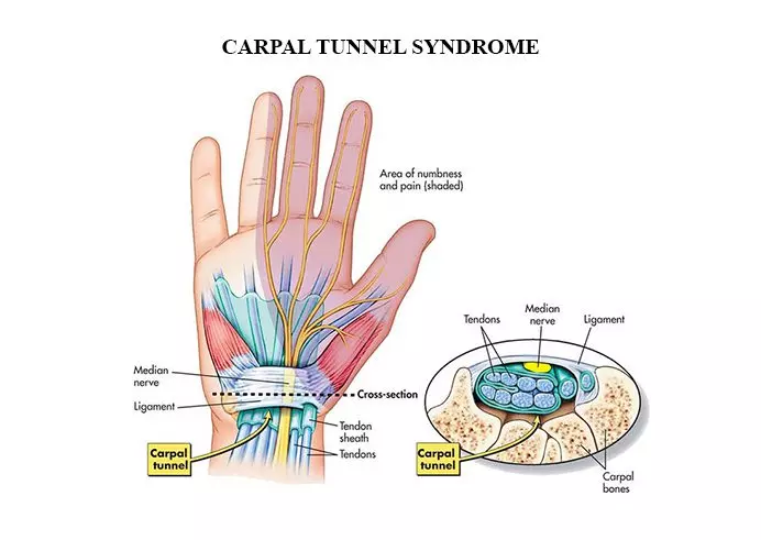 What is Carpal Tunnel Syndrome | Orchard Health Clinic