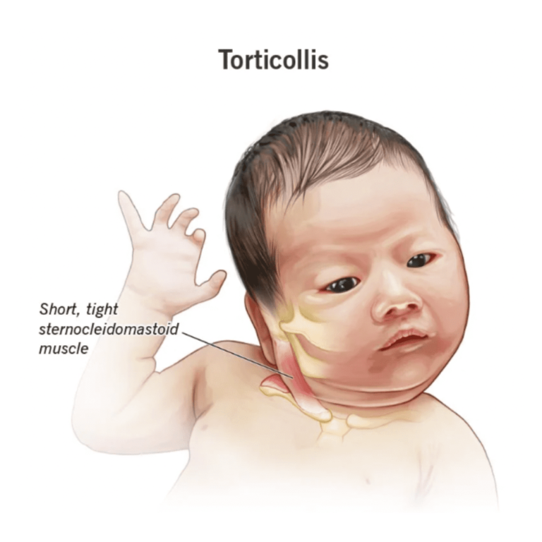 Torticollis | Orchard Health Clinic