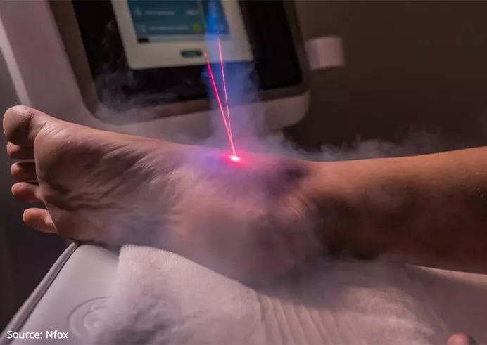 Cryotherapy treatment plantar fasciitis outlet