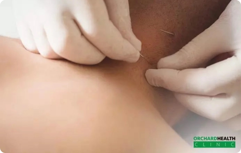 Is-it-safe-to-try-dry-needling-therapy-in-Singapore